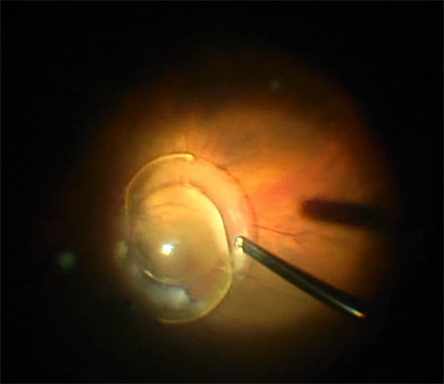 Figure 26.8.4.4 Core Vitrectomy with Retrieval of the IOL
