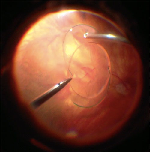 Figure 26.9.4 Bimanual Surgery is used to Remove Residual Capsule Around the Haptics to Allow for Sutureless Scleral Fixation 