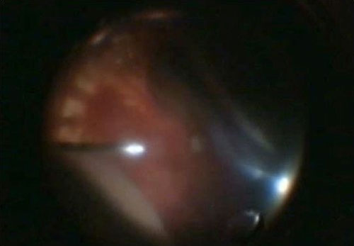 Figure 28.2 Intraoperative (Vitrectomy) View of Suprachoroidal Hemorrhage