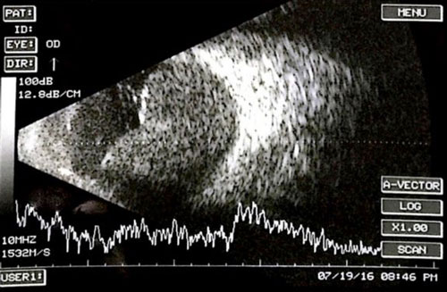 Figure 28.3 B-scan Ultrasonography 