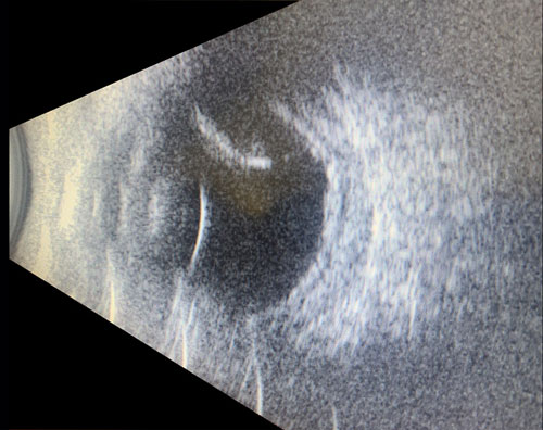 Figure 29.3 B-scan Ultrasonography Demonstrating Abnormally Thick Sclera and Serous Retinal Detachment